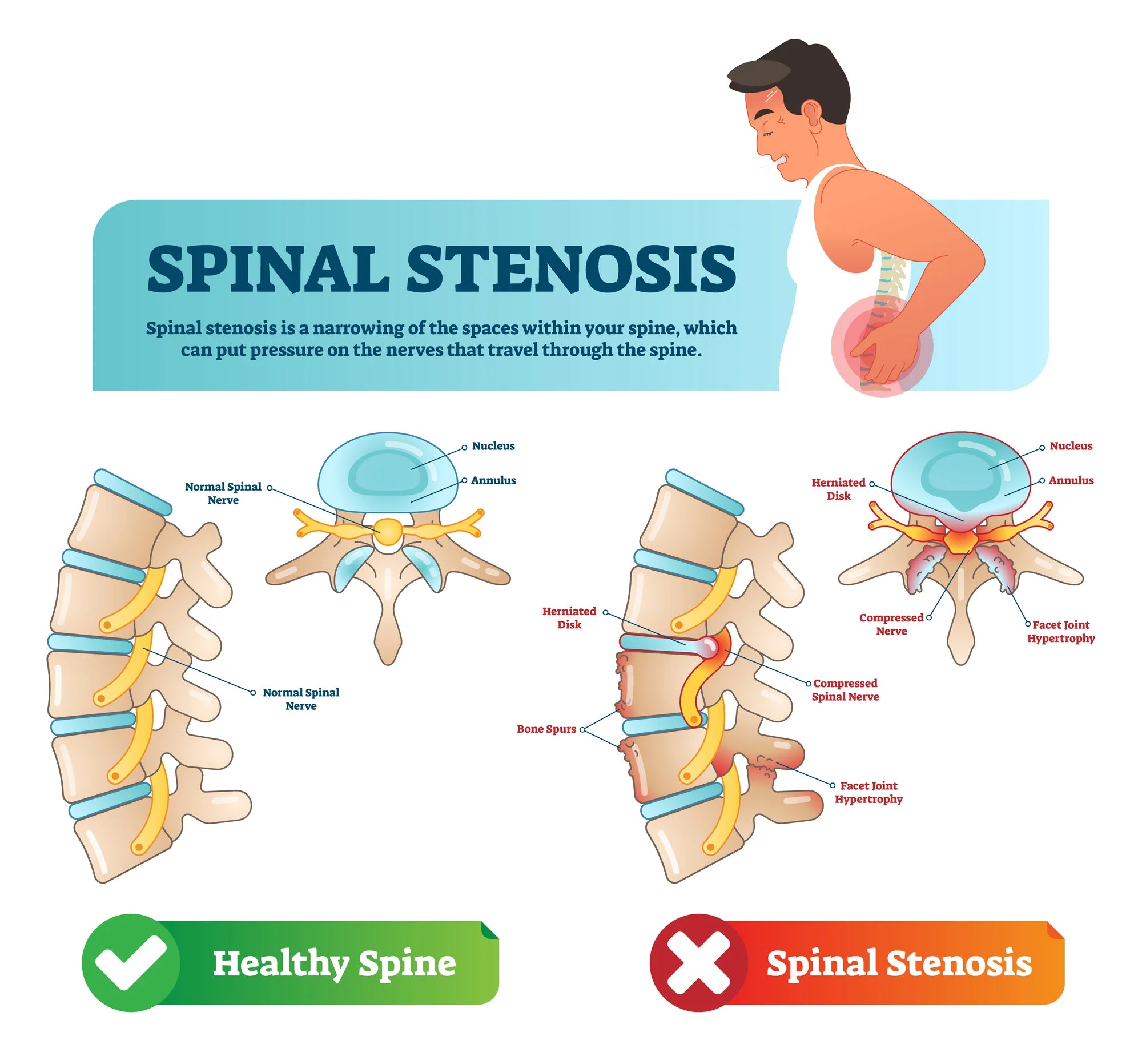 What Is the Best Walking Aid for Spinal Stenosis?
