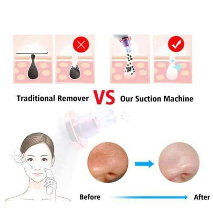 Comparison of traditional blackhead remover versus Blackhead Removal Suction Tool with before and after illustrations.